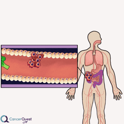 Fecal (Stool) Tests | CancerQuest